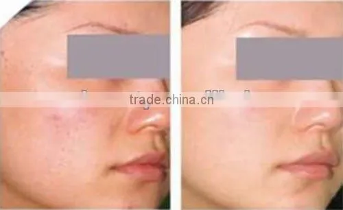 2012 Newest IPL+RF Elight machine for red capillary and acne treatment