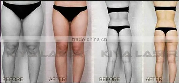 Professional and popular liposonix