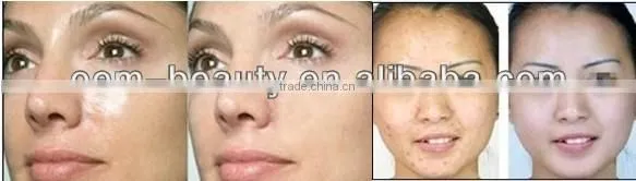 2016 Best Selling New Invention tattoo removal machine wrecking balm