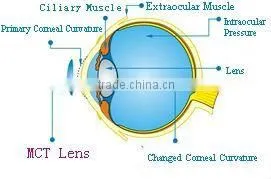 For low myopia MCT Technology high technology