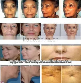 hot sale radio freuquency facial machine for anti-aging and slimming
