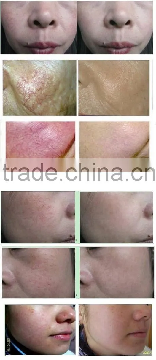 Hot Selling !! Vein Wave Machine