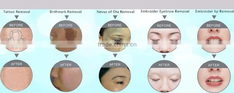 yag laser q switch tattoo removal/yag laser remove tattoo