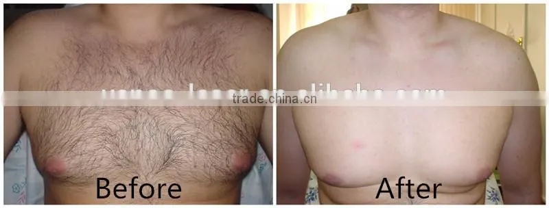 vertical 808nm diode laser hair removal machine