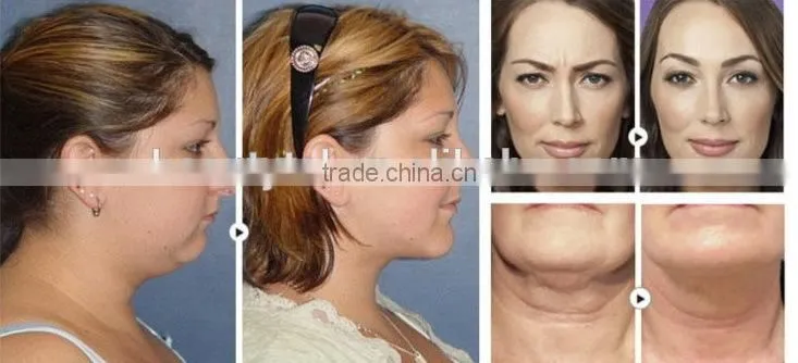 Radiofrequency micro needle rf fractional& fractional rf machine