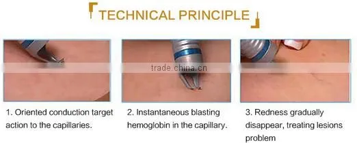 Good effects Wholesale Vascular Remover 980nm Spider Vein Removal Machine