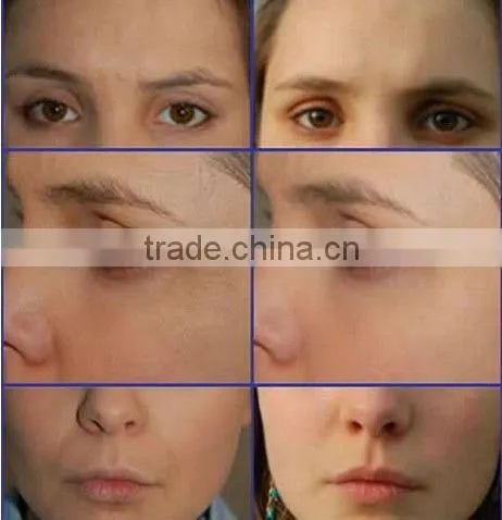 2014 Hot beauty equipment E light IPL RF ND Yag laser 4 in 1/laser machine