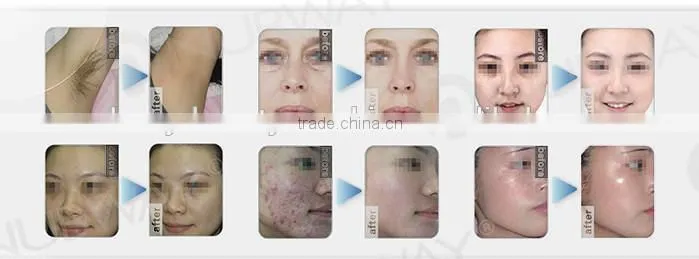 hot !!! diode laser hair removal machine