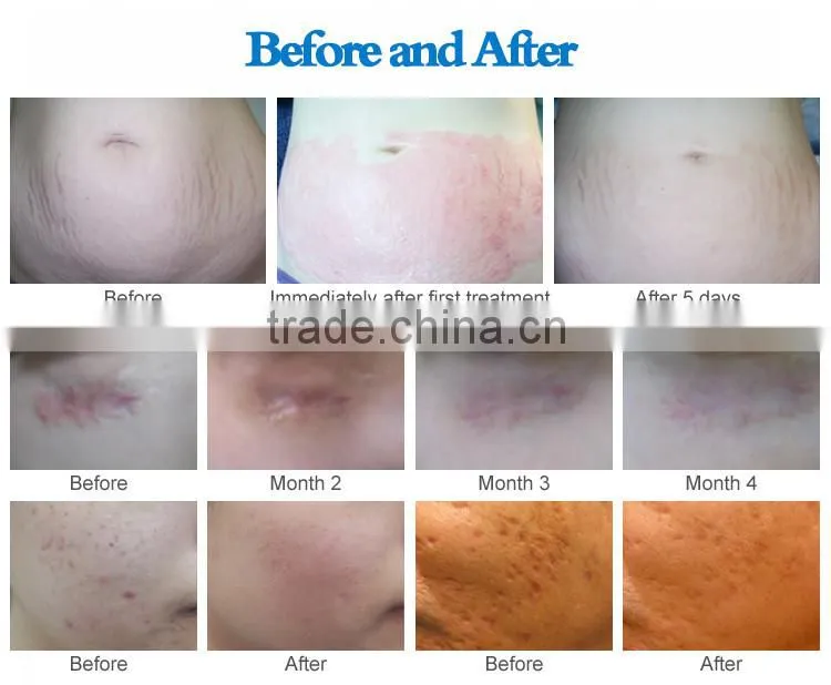 face skin anti-wrinkle electric micro needle micro needling device