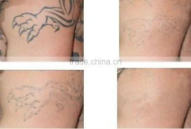 Cheap portable laser therapy equipment q switch laser machine for tattoo pigment removal D001