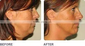 ELIGHT(IPL+RF)hair removal beauty machine