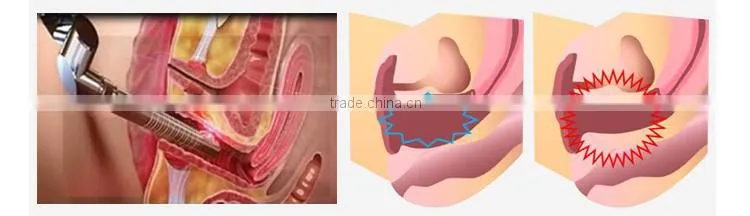 Fractional CO2 laser scar removal stretch mark removal device (With CE)