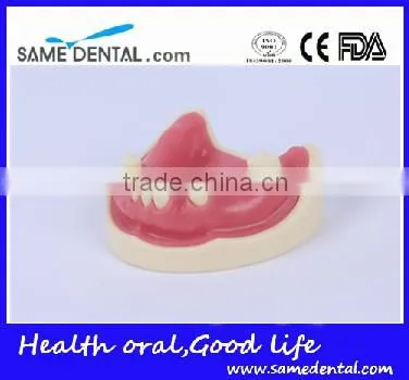 Dental Implant Practice Model With Gingival School Teaching Demonstration Models