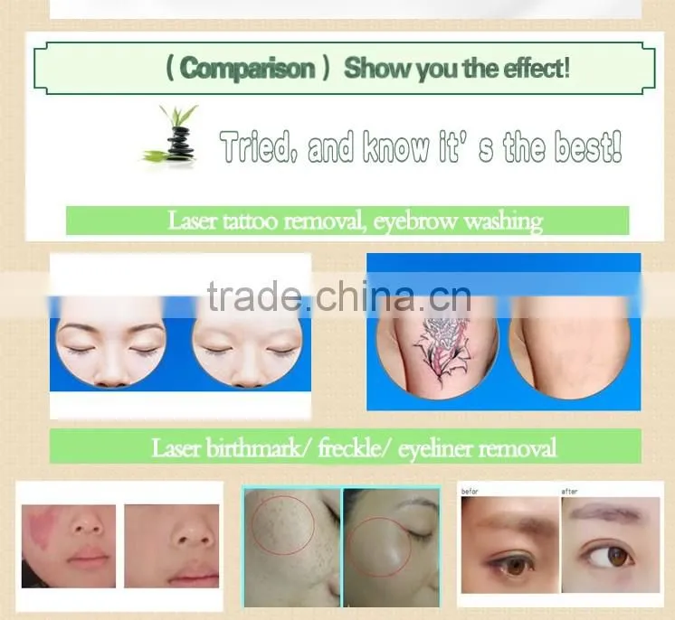 ND Yag laser tattoo eyebrow removal machine laser pistol