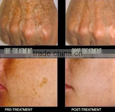 2940nm Er yag fractional laser scar removal machine HS-820
