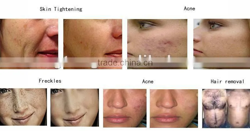 advanced ipl machine for hair removal e-light ipl+rf photo rejuvenation ipl+rf for wrinkle smoothing