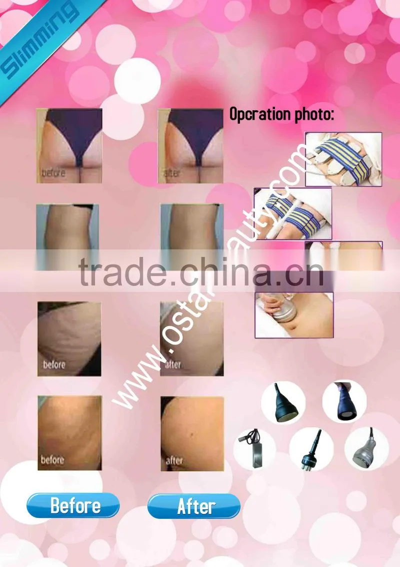 Factory wholesale rolling vacuum cavitation belly fat removal machine OB-S 01