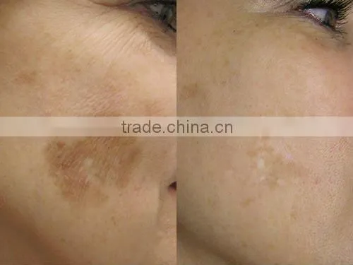 YH-1 wholesale elight permanent hair removal ipl laser hair removal machine for sale