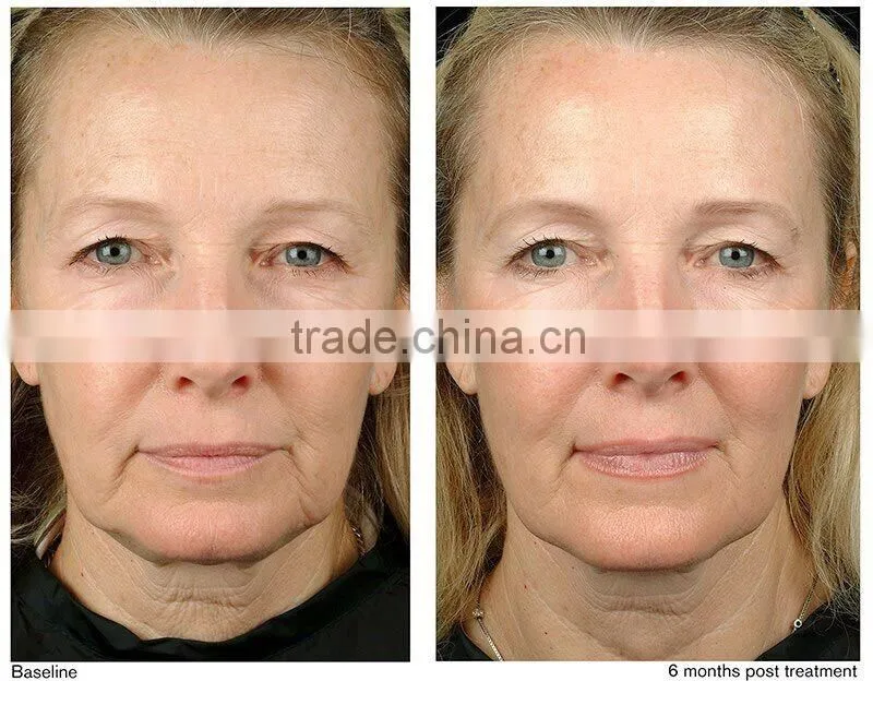 good results as HIFU 2 in 1 SHR IPL thermagic RF skin tightening machine