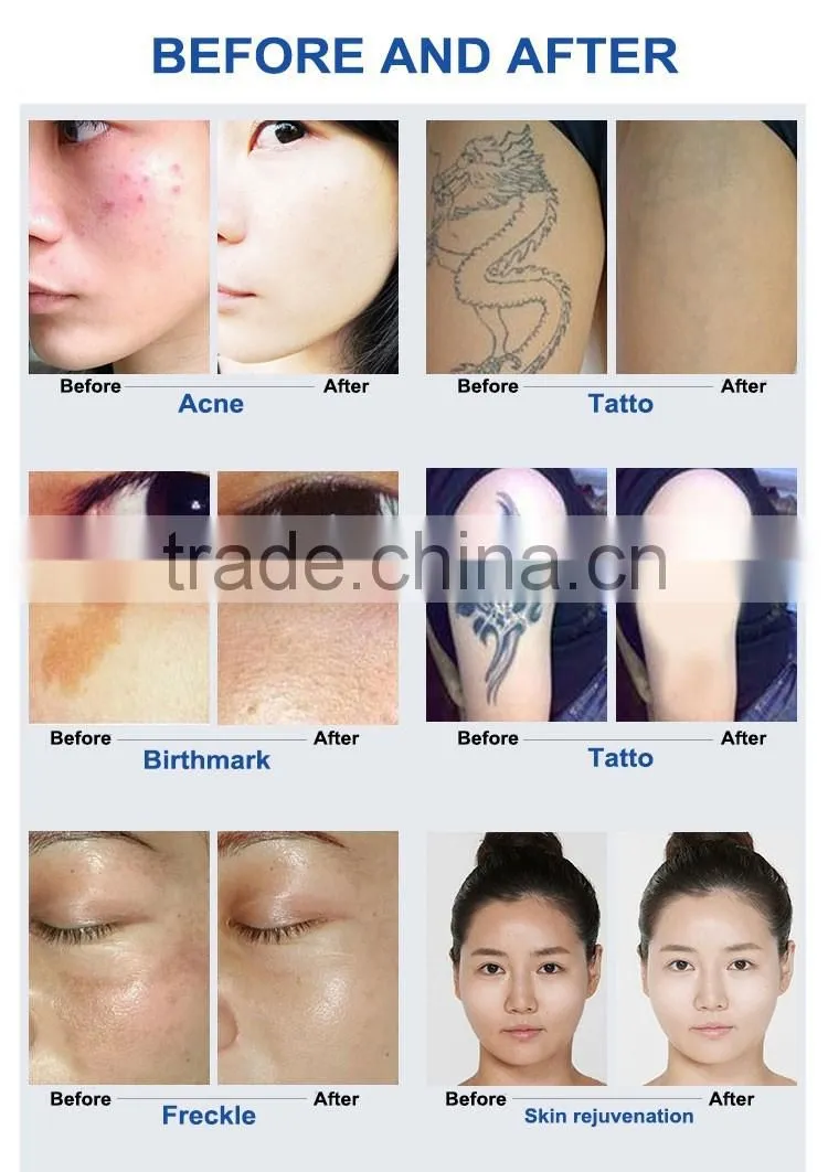 Hot sale Q switch ND YAG Laser & C8 Tattoo Removal Machine / spot Removal