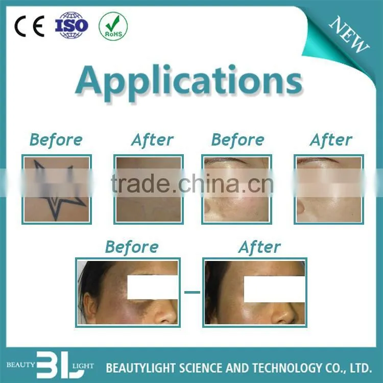hot selling q-switched nd yag laser skin carbon rejuvenation