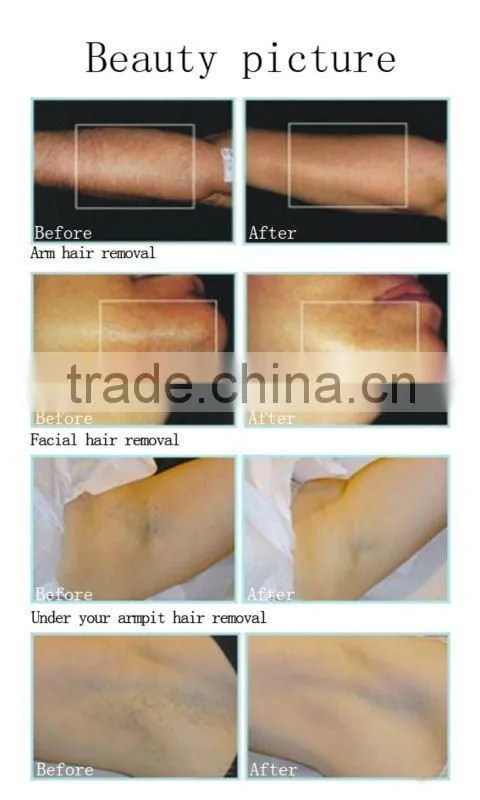 808nm Diode Laser Encounter Smooth Skin 2012