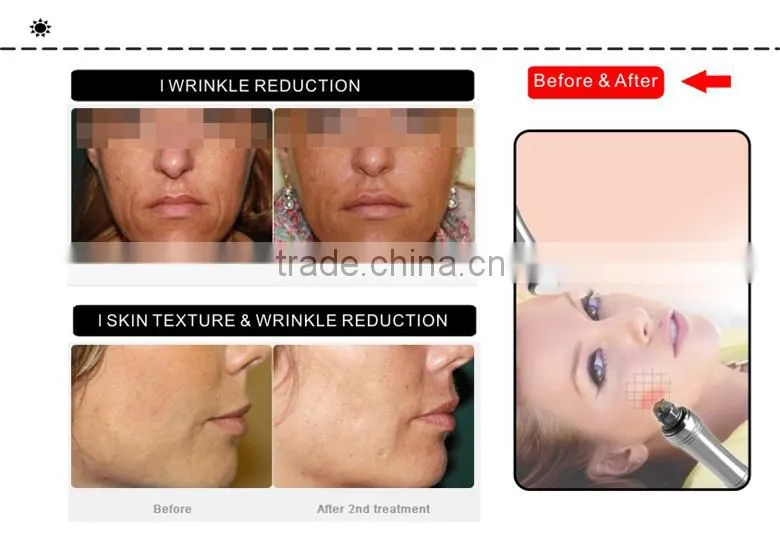 Newest Radiofrequency Microneedle Wrinkle Removal