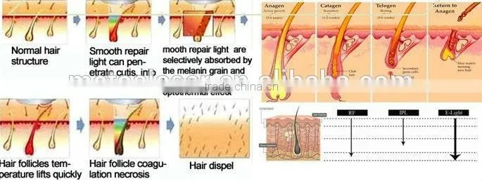 High Intensity RF Machine for Skin Tightening Face Lifting