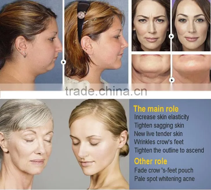 portable rf wrinkle removal face lifting device from weifang KM