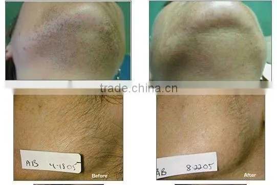 Constant Multi-pulse IPL Hair Removal &Skin Rejuvenation Beauty Machine-A005