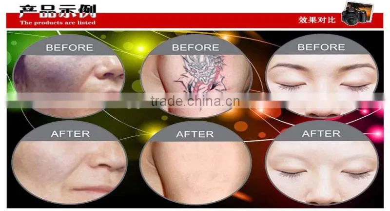 Laser Tatoo removal Equipment / q-switched laser prices