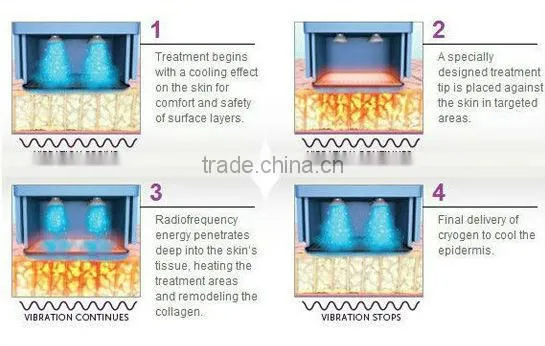 2014 best rf skin tightening face lifting machine/bipolar and monopolar rf