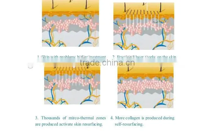 medical device scar removal fractional co2 for hospital use