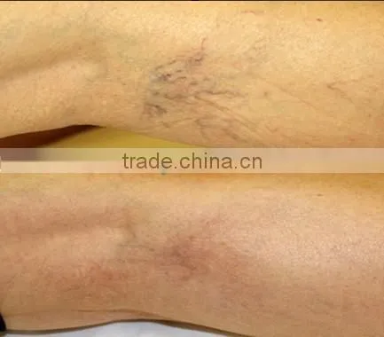 1064nm Long pulse laser machine for hair removal,skin rejuvenation -P003