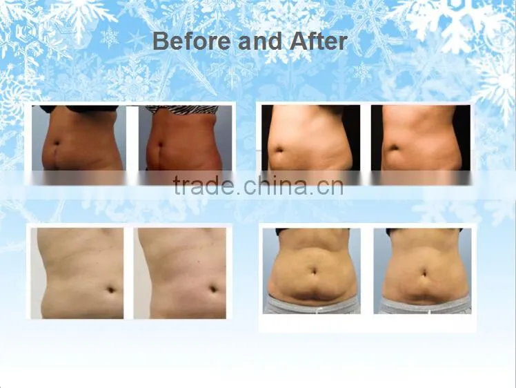 cryolipolysis + criolipolisis machine + portable cryolipolysis machine for home use CRYO6S