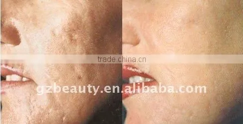 WF-19 Personal dermabrasion skin peeling machine