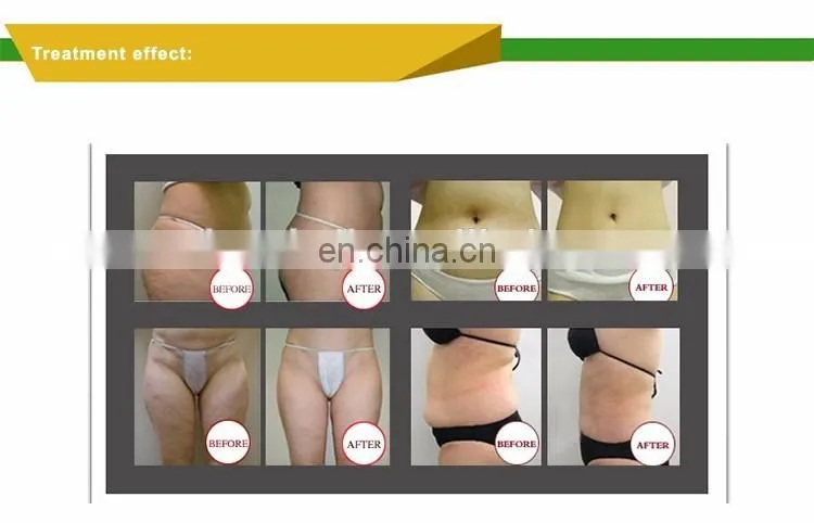 Vacuum Roller Slimming Machine / Vela slim 3 / Vela slim Shape machine