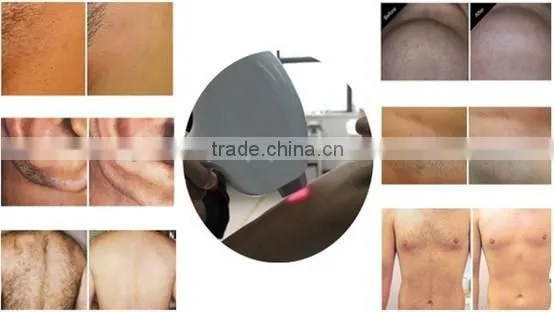 Newest mode portable diode laser hair removal professional 808nm diode laser hair removal machine