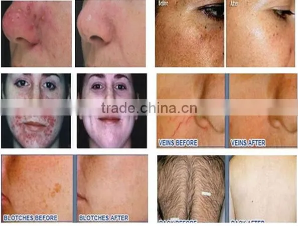 3000W Big Power !!! Fast Permanent hair removal ipl equipment / ipl shr laser