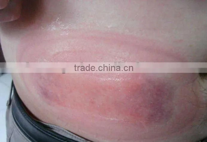 Hot Sale! cold sculpting machine, slimming machine, cryolipolysis