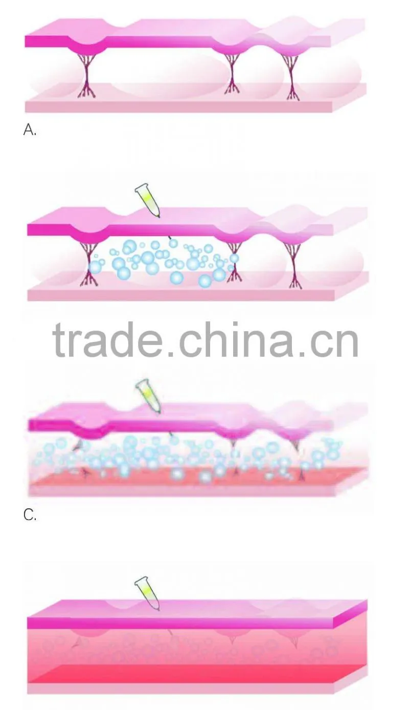 Needles /Filters medical CO2 gas/C2P/ Co2 gas/CDT GAS for CDT machine/CDT machine/CDT carboxy therapy machine