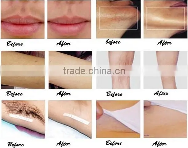 Wrinkle removal machine with 3 in 1 function factory direct sale