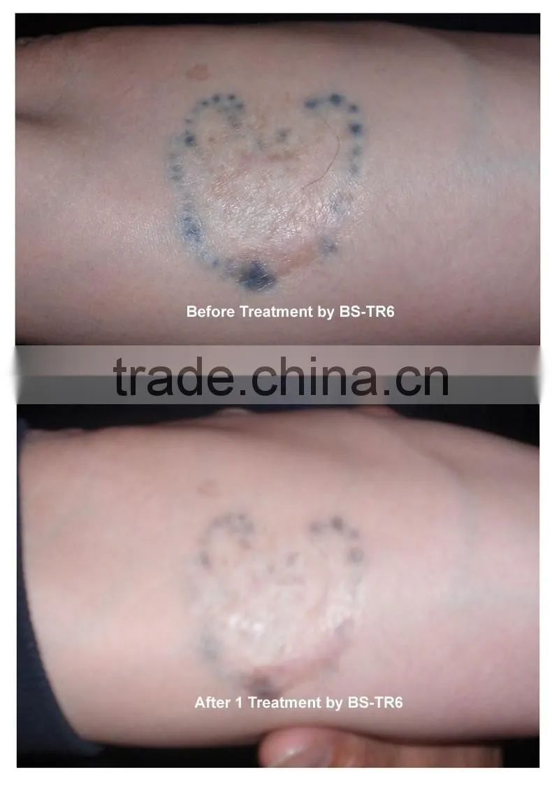 q switch laser tattoo removal machine for skin tattoo treatment