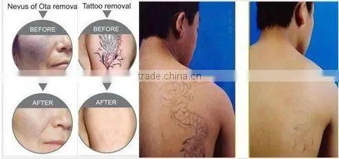 2016 Hot sale laser tattoo removal machine for beauty salon use