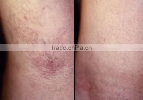 2016 best selling your first choice 1064nm laser epilator for sale P001
