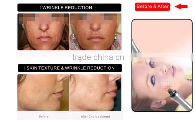 Micro-Needle RF scar and wrinkle removal equipment -MNF100