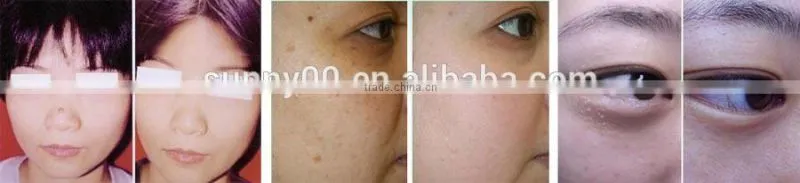 Professional High Quality Medical co2 Laser for General Surgical Equipment
