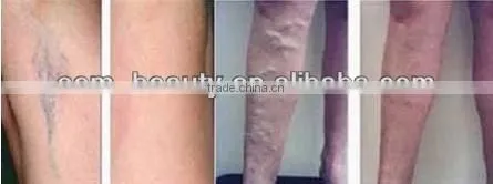 portable laser nd yag therapy long pulse laser equipment -P003
