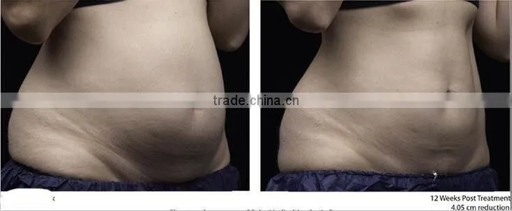 New fat killer HIFU slimming machine