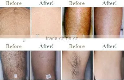 2016 New Permanent Hair Removal Machine Korea IPL
